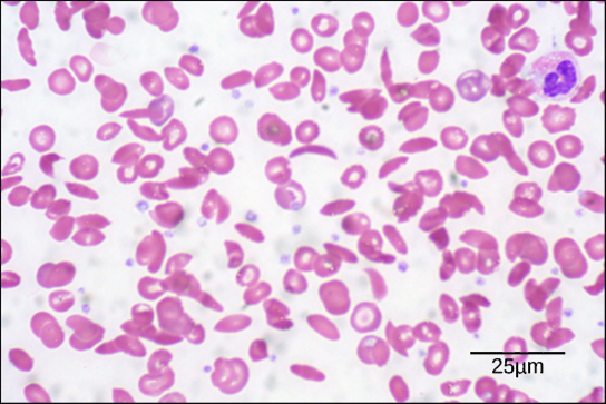 The micrograph shows a smear of red blood cells, some are disc-shaped and compressed in the center, whereas some are crescent-shaped. Each red blood cell is about five microns across.