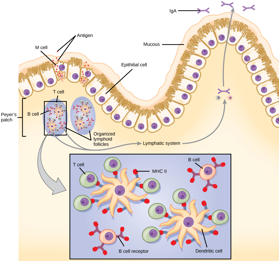 The intestine is lined with epithelial cells with hair-like cilia extending into the intestinal lumen. M cells are sandwiched between these epithelial cells, in bump-like projections in the intestinal lining. The M cells are shaped like an upside-down U, with the U forming a pocket on the interior surface. Antigens are taken up from the intestinal lumen by the M cells, and excreted into this U-shaped pocket. Dendritic cells in the pocket ingest the antigen, then migrate to an area below of the intestinal lining called a Peyer’s patch. The dendritic cells, T cells and B cells aggregate to form clumps of cells called organized lymphoid follicles. There, some T cells interact with antigen associated with MHC II on the surface of the dendritic cells. Some B cells are activated by free antigen. Some antigen-presenting dendritic cells enter the lymphatic system, where more B and T cells are activated in the lymph nodes. The B cells and T cells return to bigger bumps in the intestinal epithelium called MALT effector sites. Antibodies are secreted into the intestinal lumen.