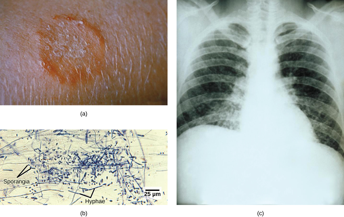 Part a is a photo of a red, ring-shaped skin lesion. Part b is a light micrograph of long, thread-like mycelia and small, oval sporangia. Part c is a chest X-ray of a person with a fungal infection. There are diffuse, scattered light areas where the infiltration of fluid has replaced the air in the microscopic air sacs.