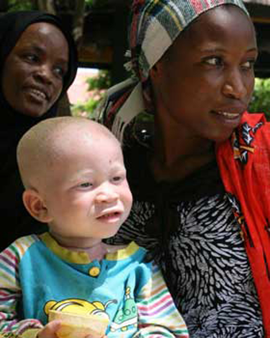 Photo shows a mother with an albino child.