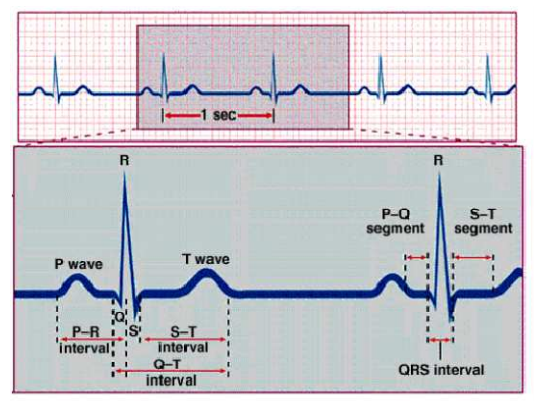 ECG trace