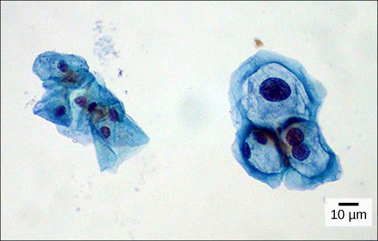 Both normal cells and cells infected with HPV have an irregular, round shape and a well-defined nucleus. The infected cells, however, are two to three times as large as uninfected cells, and some have two nuclei.