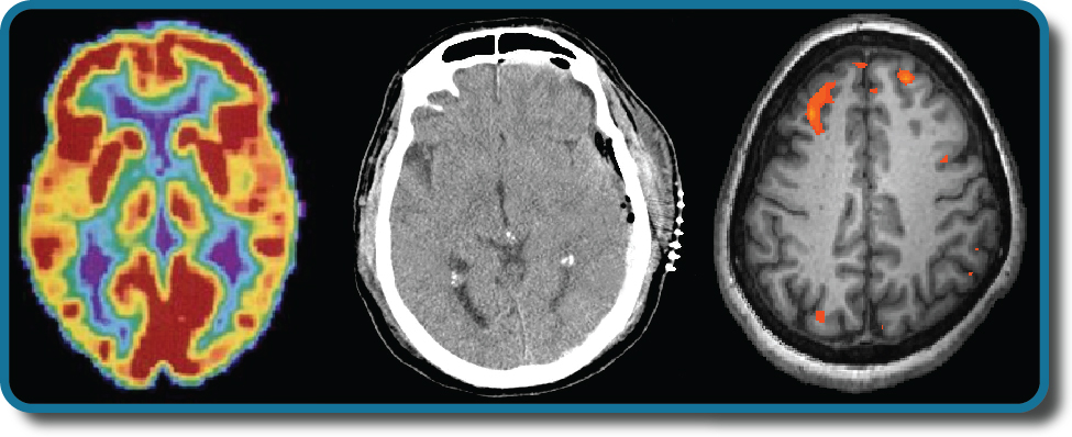 Three brain-imaging scans are shown.