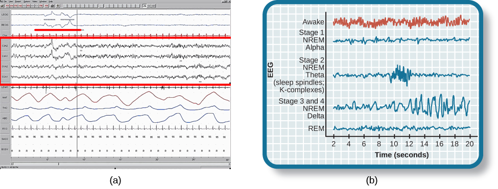 Chart A is a polysonograph with the period of rapid eye movement (REM) highlighted.Chart b is a shows brainwaves at various stages of sleep, with the “awake” stage highlighted to show its similarity to the wave pattern of “REM” in part A.