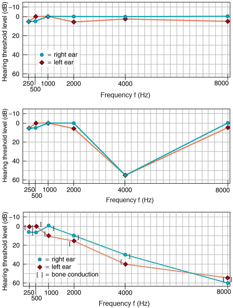 Three audiogram output graphs of three individuals’ left and right ear are shown. The graph is for hearing threshold level verses frequency in hertz. The hearing threshold level is on Y axis and frequency is along X axis. The first graph has two curve nearly parallel to X axis. The second graph is straight for some range then has a dip at four thousand hertz. The third graph has a falling curve toward X axis from a maximum value on Y axis.