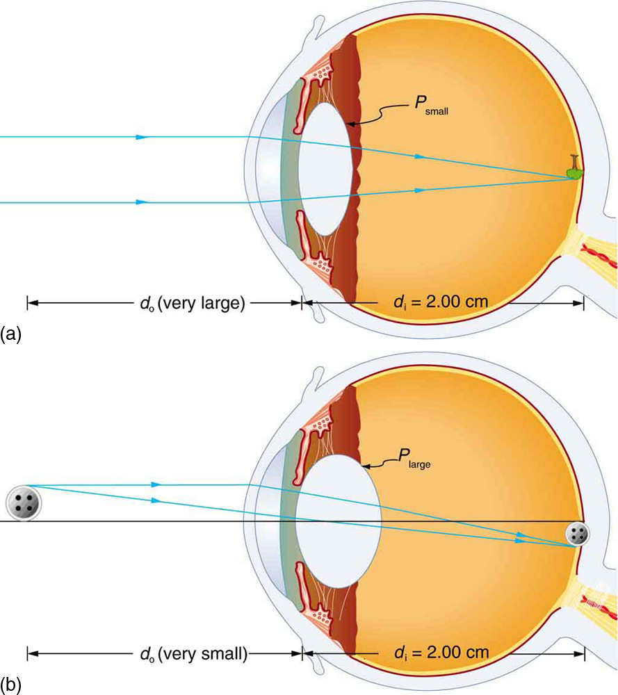 Two cross-sectional views of eye anatomy are shown. In part a of the figure, parallel rays from distant object are entering the eye and are converging on the retina to produce an inverted image of the tree shown above the principle axis. The interior lens of the eye is relaxed and least rounded, given as P small. Distance of image d i is equal to two centimeters, which is the measure of the distance from lens to retina. Distance of object d o is given as very large. In part b of the figure, rays from a button, which is a nearby object, are shown to diverge as they enter the eye. The interior lens of the eye, P large, converges the rays to form an image at retina, below the principle axis. Distance of image d i is equal to two centimeters, which is the measure of distance from lens to retina. Distance of object d o is given as very small.