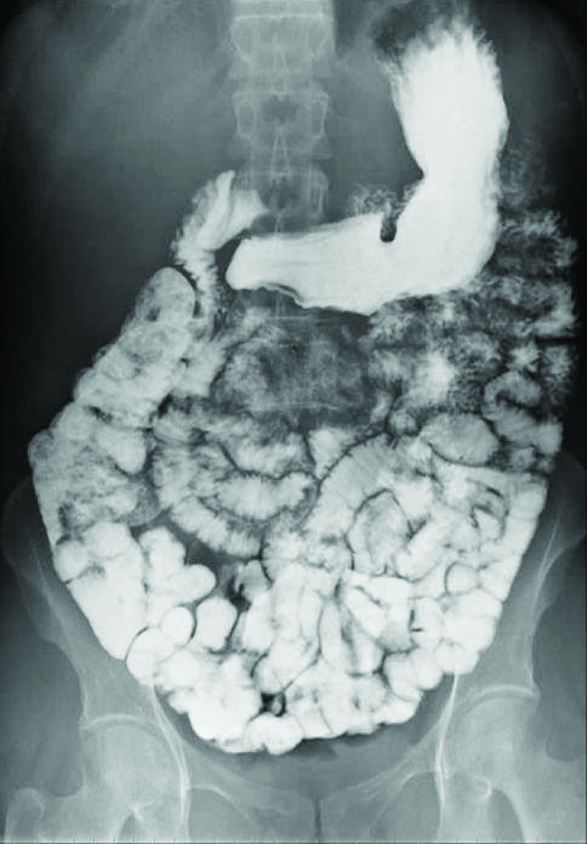 This figure contains one image. A black and white abdominal x-ray image is shown in which the intestinal tract of a person is clearly visible in white.