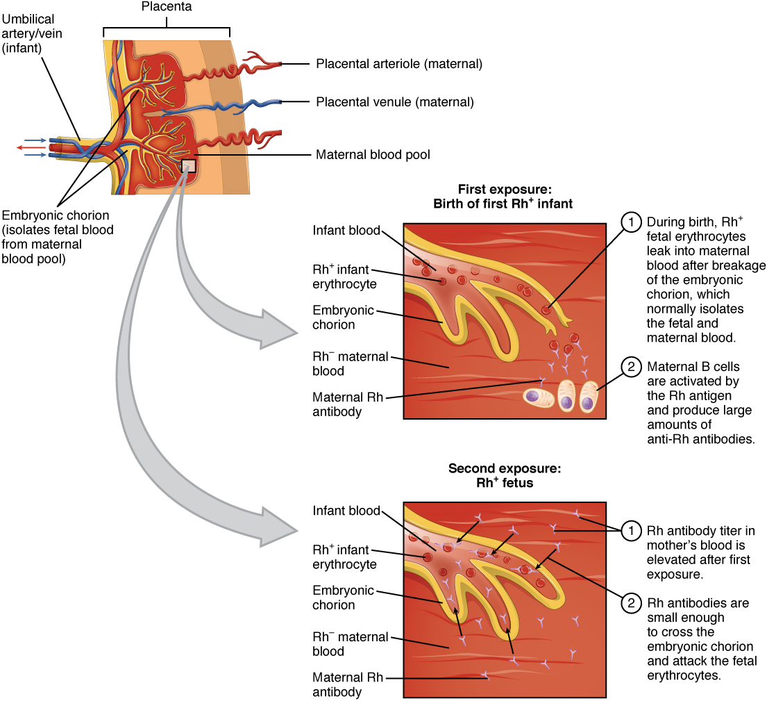 This figure shows the progression of thedisease called erythroblastosis fetalis. The top panel shows the umbilical artery and vein and the placenta. The center panel shows the response in the immune system of a first Rh+ infant. The bottom panel shows the response in the case of a second exposure for a Rh+ infant.