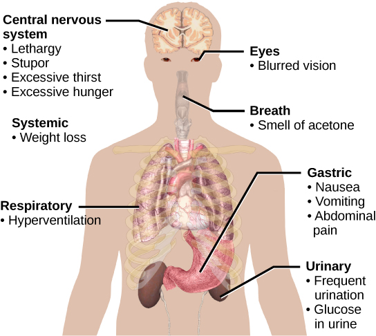 Symptoms of diabetes include excessive thirst, excessive hunger, lethargy and stupor, blurred vision, weight loss, breath that smells like acetone, hyperventilation, nausea, vomiting, abdominal pain, frequent urination, and glucose in the urine.