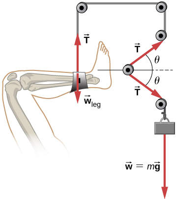 Figure shows a leg on the left. It is attached to a rope at the ankle and suspended from a pulley at the top. The rope continues to a second pulley on the right of the first, a third one to the bottom of the second, a fourth one to the bottom left of the third and a fifth one to the bottom right of the fourth. An object with weight w = mg is attached at the end of the rope. An arrow labeled w subscript leg points downwards from the ankle and an arrow labeled T points upwards from there. An arrow labeled T, from the fourth pulley to the third, forms an angle theta with the horizontal. Another arrow labeled T, from the fourth pulley to the fifth forms an angle minus theta with the horizontal.