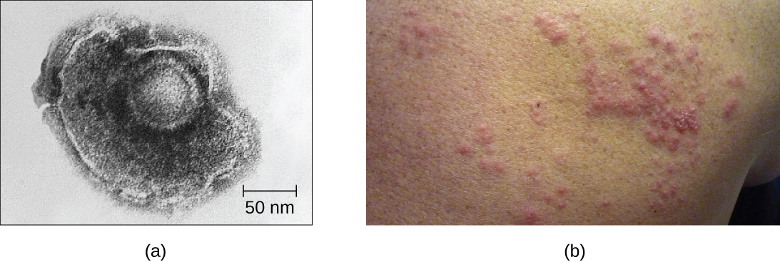 Figure a is an electron micrograph that shows a a shpere within a larger blob-shaped structure. Figure b shows raised red dots on a person’s back.