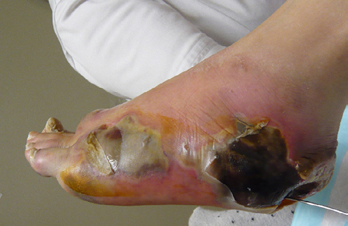 A swollen foot with peeling skin and black regions under the skin.