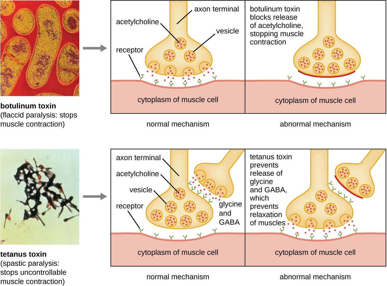 Botulinum toxin causes flaccid paralysis and stops muscle contraction. The diagram shows that the normal mechanism has acetylcholine released at the axon terminal. The acetylcholine then binds to receptors on the membrane of a muscle cell. The abnormal mechanism – botulinum toxin blocks the release of acetylcholine stopping muscle contraction. Tetanus toxin causes spastic paralysis; uncontrollable muscle contraction. The normal mechanism shows glycine and GABA released from one axon terminal and binding to receptors on another axon terminal. This causes acetylcholine to remain in the vesicles and not bind to the receptors on the muscle cell. In the abnormal mechanism tetanus toxin prevents the release of glycine and GABA. Therefore acetylcholine is released and binds to receptors on the muscle. This prevents the relaxation of muscles.