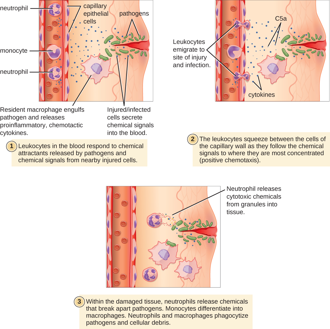 A diagram with 3 steps. The first step states: leukocytes in the blood respond to chemical attractants released by pathogens and chemical signals from nearby injured cells. An injury to the surface of the skin is labeled: injured/infected cells secrete chemical signals into the blood. Pathogens are present in the wound. Neutrophils and monocytes are in the blood stream; and the outside of the vessel is labeled capillary epithelial cells. A resident macrophage engulfs the pathogens and releases proinflammatory chemotactic cytokines. The second step states: the leukocytes squeeze between the cells of the capillary wall as they follow the chemical signals to where they are most concentrated (positive chemotaxis). The leukocytes emigrate to the site of injury and infection. The chemical signals present include C5a and cytokines. The third panel states: Within the damaged tissue, neutrophils release chemicals that break apart pathogens. Monocytes differentiate into macrophages. Neutrophils and macrophages phagocytize pathogens and cellular debris. Neutrophils release cytotoxic chemicals from granules into tissue.