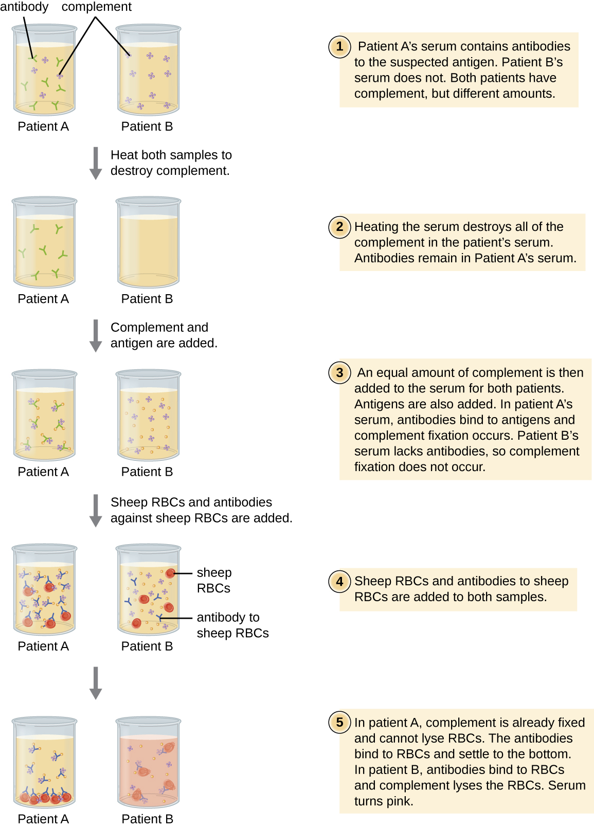 Diagram of the complement fixation test. 1. Patient A’s serum contains antibodies to the suspected antigen. Patient B’s serum does not. Both patients have complement, but different amounts. 2. Heating the serum destroys all of the complement in the patient’s serum. Antibodies remain in Patient A’s serum. 3. An equal amount of complement is then added to the serum for both patients. Antigens are also added. In patient A’s serum, antibodies bind to antigens and complement fixation occurs. Patient B’s serum lacks antibodies, so complement fixation does not occur. 4. Sheep RBCs and antibodies to sheep RBCs are added to both samples. 5. In patient A, complement is already fixed and cannot lyse RBCs. The antibodies bind to RBCs and settle to the bottom. In patient B, antibodies bind to RBCs and complement lyses the RBCs. Serum turns pink.