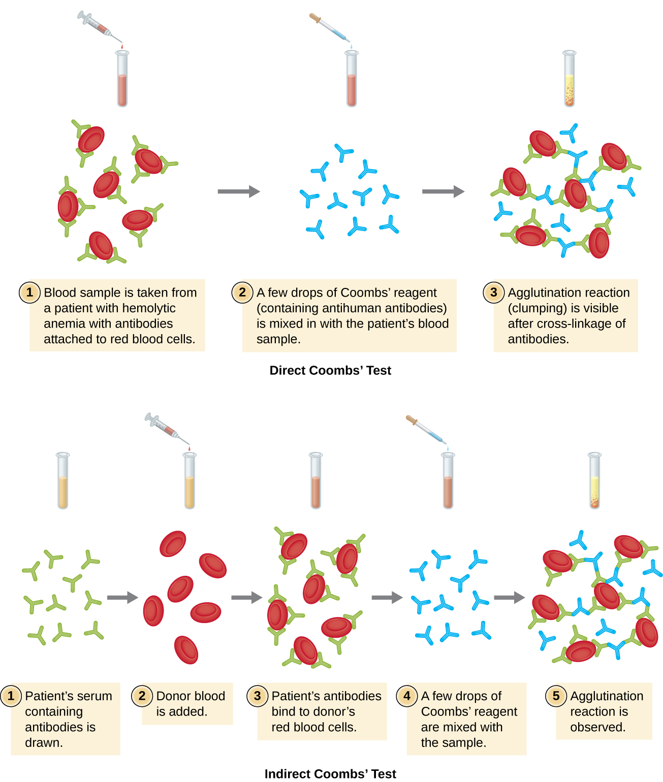 A) Diagram of direct Coomb’s test. 1.  Blood sample from a patient with hemolytic anemia with antibodies attached to red blood cells. 2. Antibodies coat the patient’s red blood cells. 3. A few drops of Coomb’s reagent (containing anti-human antibodies) is mixed in with the patient’s blood sample. 4. Agglutination reaction (clumping) is visible after cross-linkage of antibodies. B) Diagram of indirect Coomb’s test. 1. Patient's serum containing antibodies is drawn. 2. Donor blood is added. 3. Patient's antibodies bind to donor's red blood cells. 4. A few drops of Coombs’ reagent are mixed with the sample. 5. Agglutination reaction is observed.