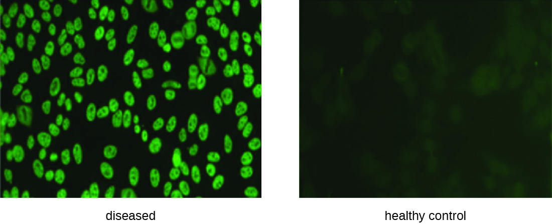 Two micrographs. The diseased sample has glowing green ovals, the healthy control does not.