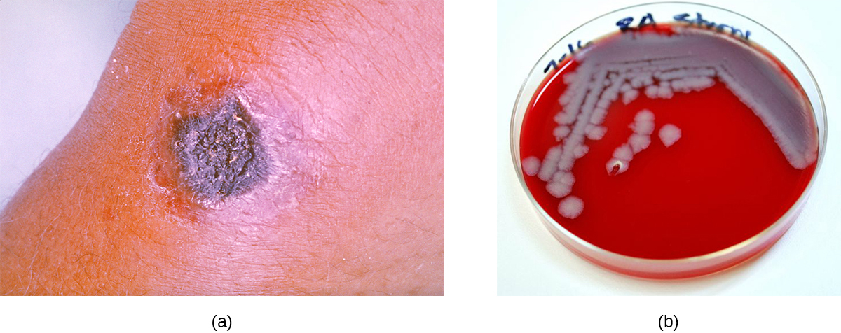 a) A black nodule on skin. b) A red plate with grey colonies.