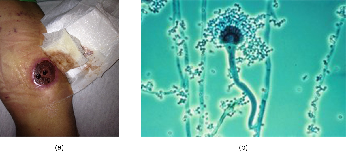 a) photo of a large, round, dark area on their leg. B) many think strands and small dots. One of the strands ends in a sphere with long chains of dots around the top part of the structure.