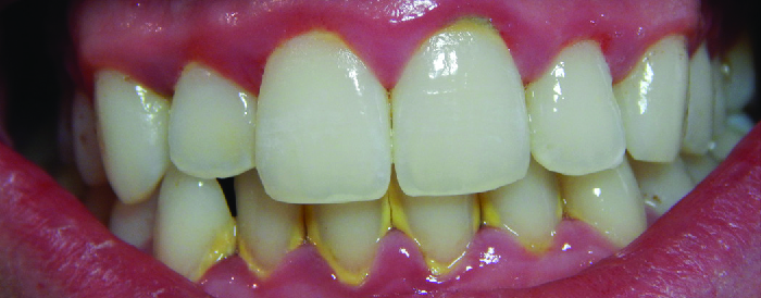 Photo of teeth with yellowing and red inflamed gums.