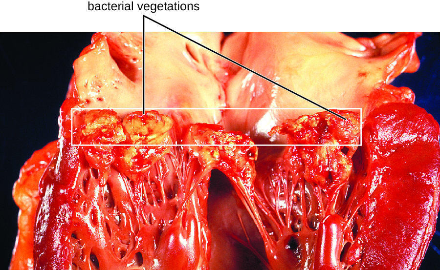 a heart with subacute bacterial endocarditis. There are thick, swollen strands in the heart. There are also large lumpy structures at the ends of the chordae tendinae.