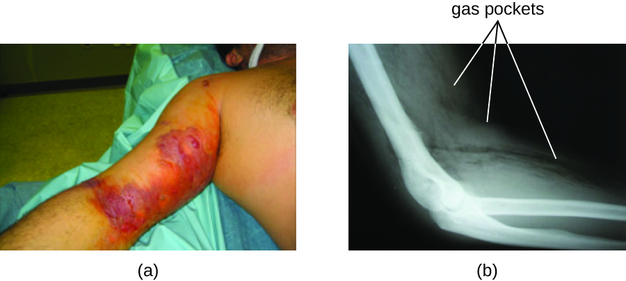 a) Photo of an arm with large purple and red regions. B) X-ray of an arm showing white muscles and cloudy skin. A dark black band cuts through the skin.