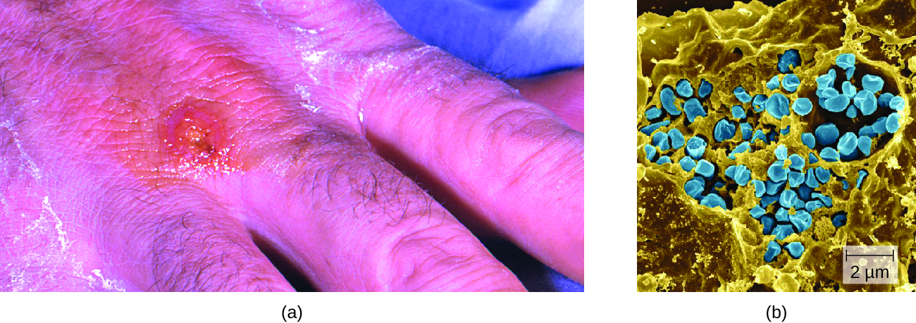 a) photo of a red blister on a hand. B) micrograph of circular cells.