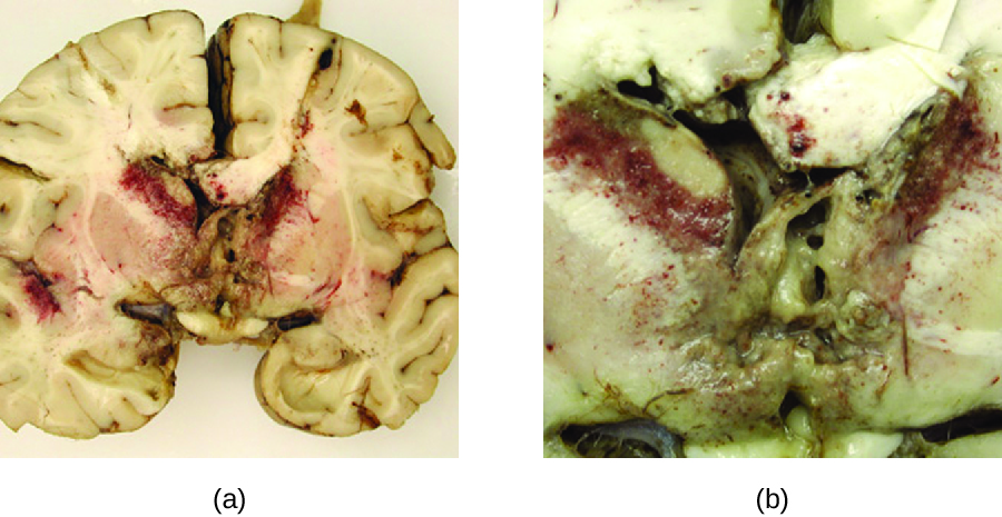 a) Photo of brain section with red granules in the center. b) close-up of granules.